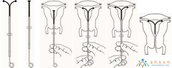宫内节育器的4种作用原理